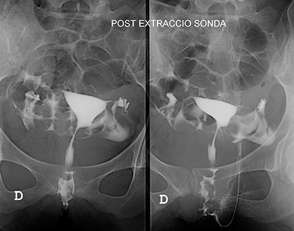 Histerosalpingografia
